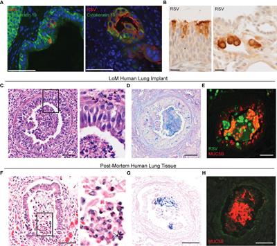 RSV infection of humanized lung-only mice induces pathological changes resembling severe bronchiolitis and bronchopneumonia